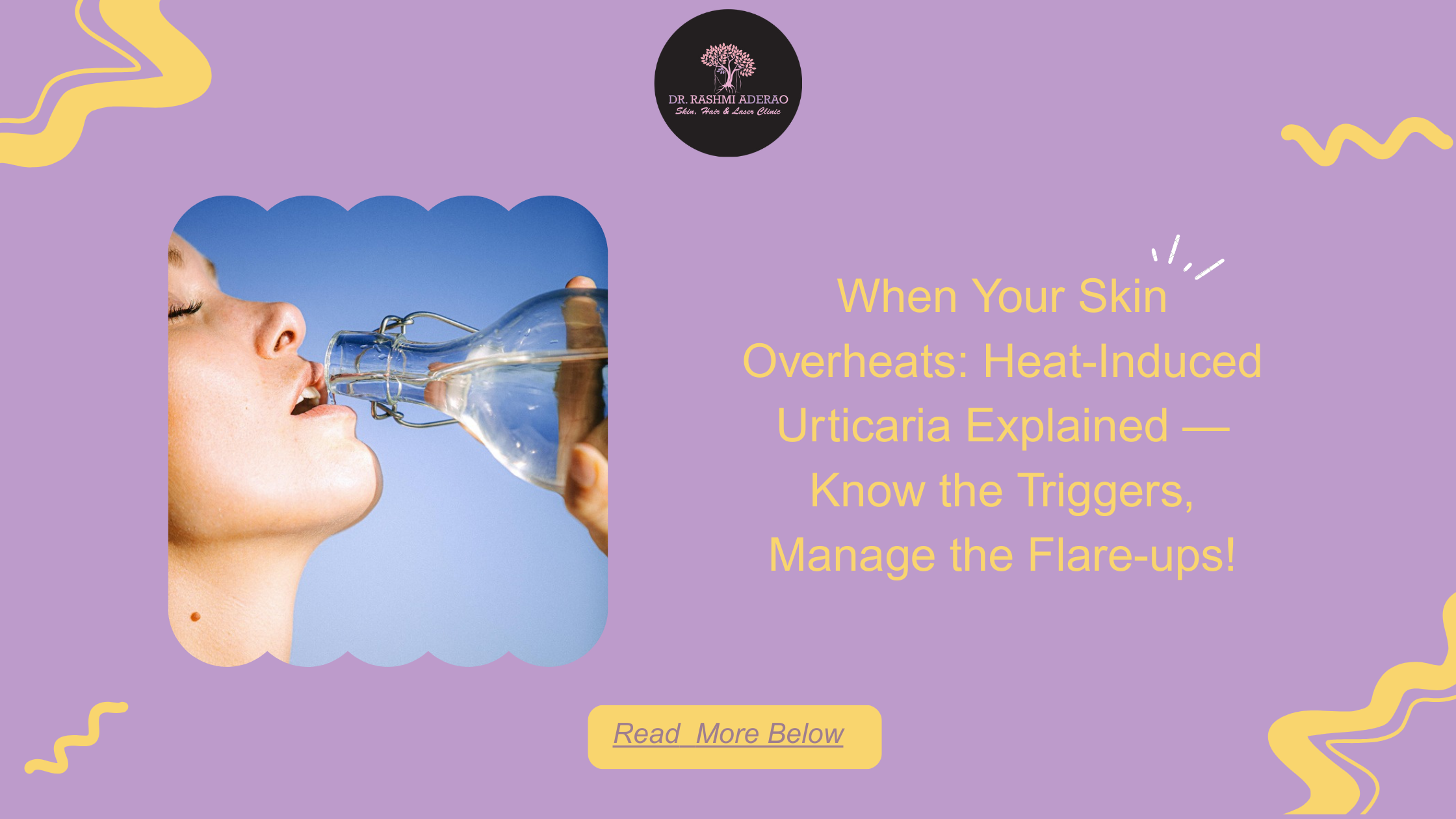 Heat-Induced Urticaria: What It Is, Why It Happens & How to Manage It