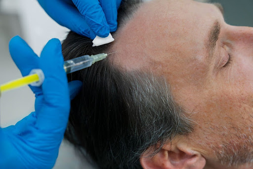 PRP and GFC Hair Loss Treatment in Pune – Advanced Solutions for Hair Regrowth