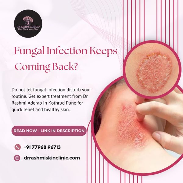 Skin Fungal Infection Treatment in Kothrud Pune – Dr. Rashmi Aderao Dermatologist