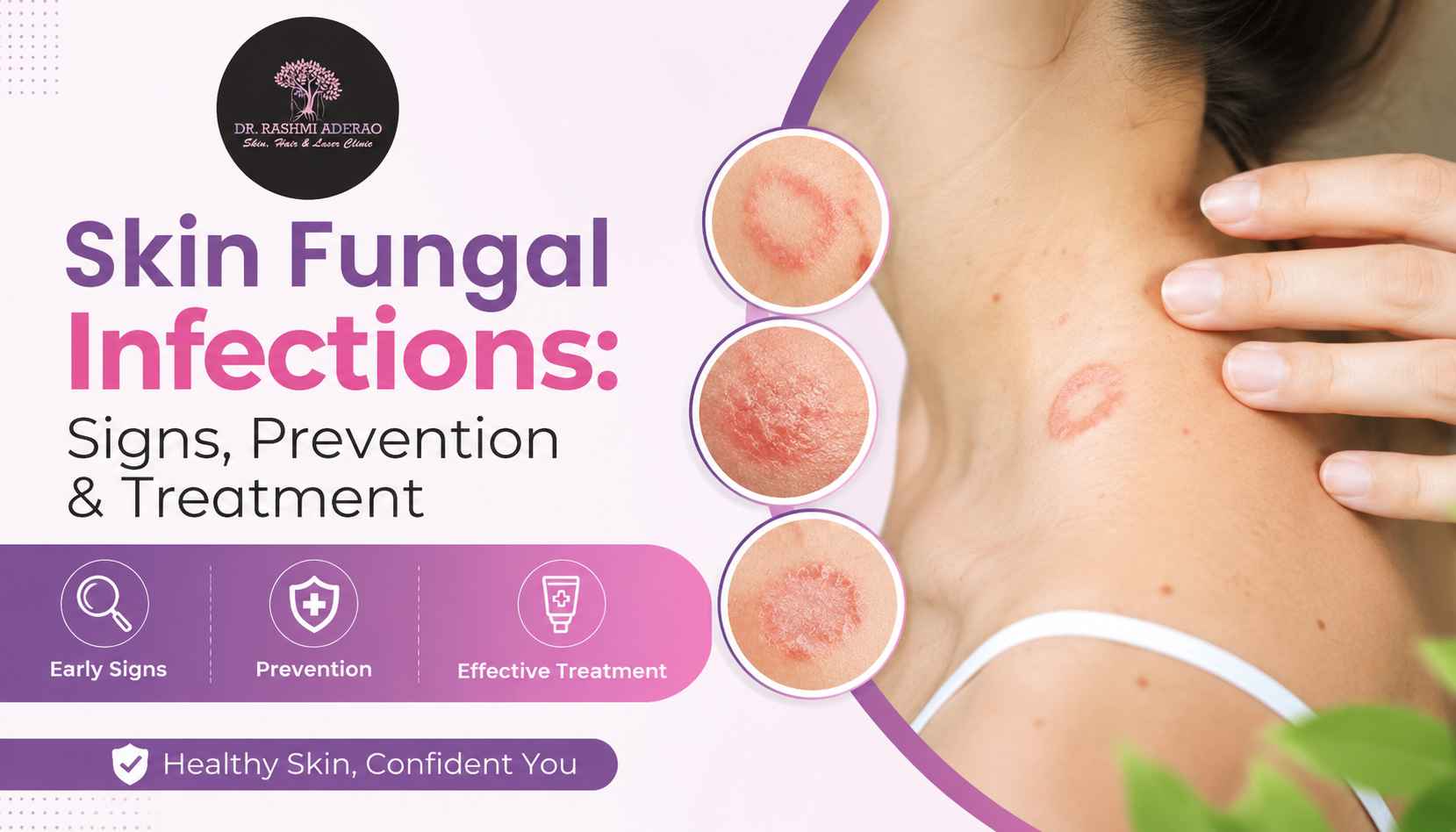Skin Fungal Infections: Early Signs, Prevention, and Effective Treatment